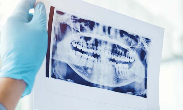 Holding up dental x-ray